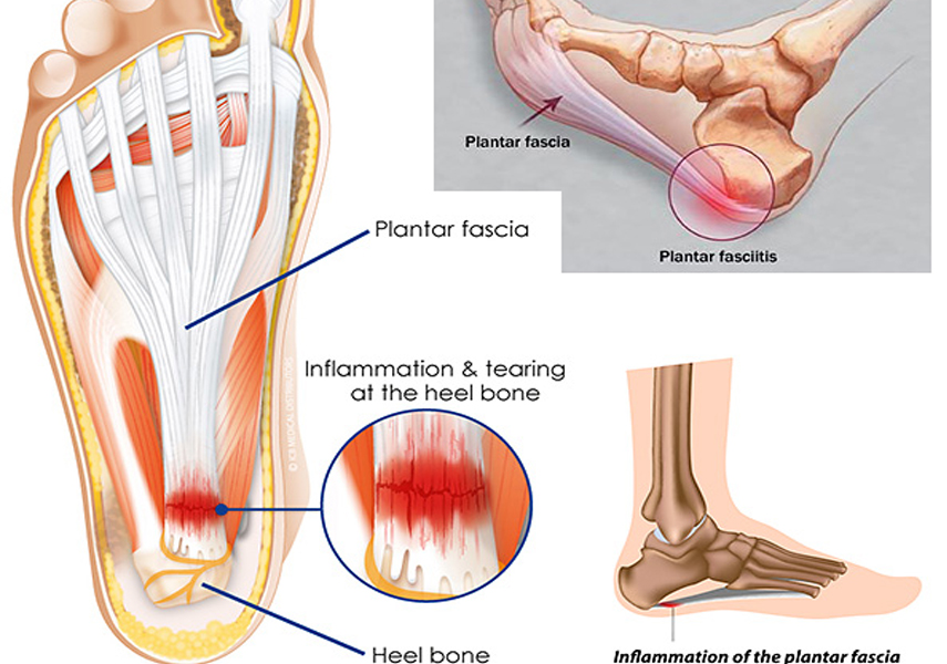足底筋膜炎のメカニズム | STARTLE｜PHYSIOスポーツ医科学研究所