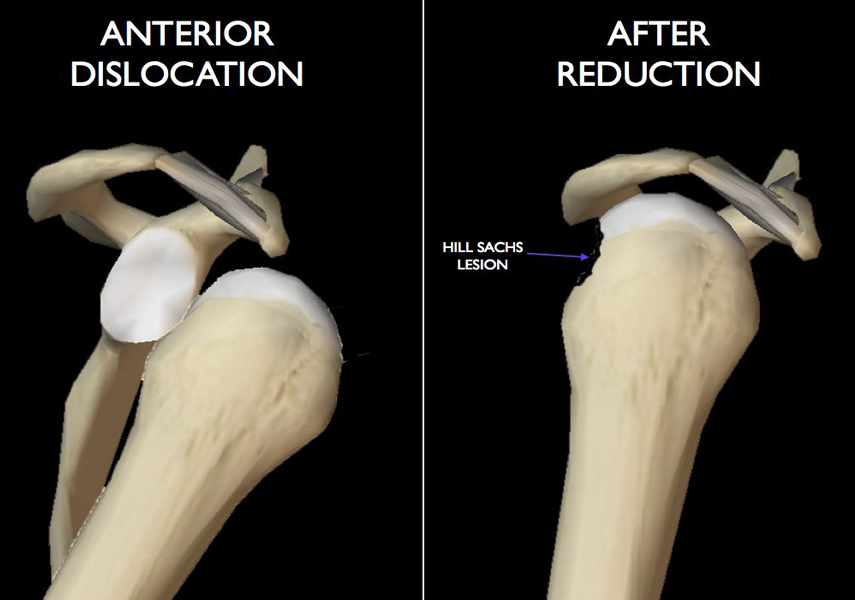 肩関節の安定化機構と肩関節前方脱臼の病態 Startle Physioスポーツ医科学研究所